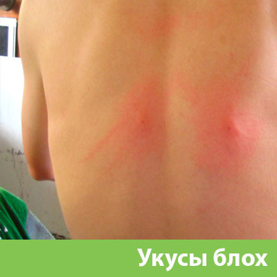 Укусы блох в Ногинске