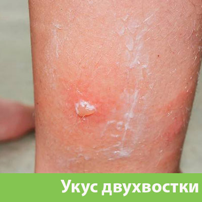 Укус двухвостки в Ногинске