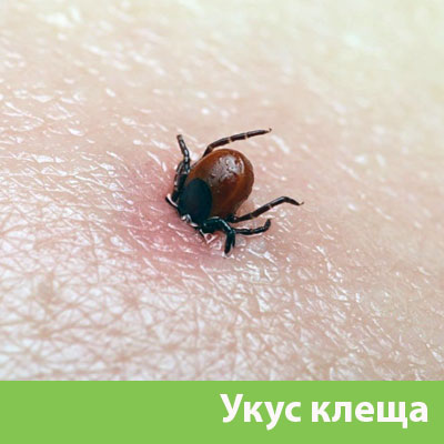 Укус клеща в Ногинске