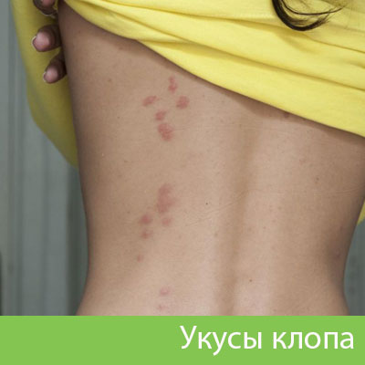 Профессиональное уничтожение клопов в Ногинске